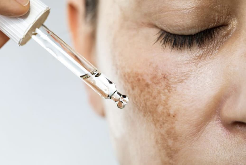 Serum applied to Hyperpigmentation