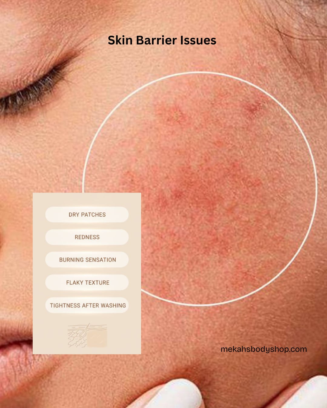 Skin Barrier Issues can be dry patches, redness, burning sensation, flaky texture, and tightness after washing.